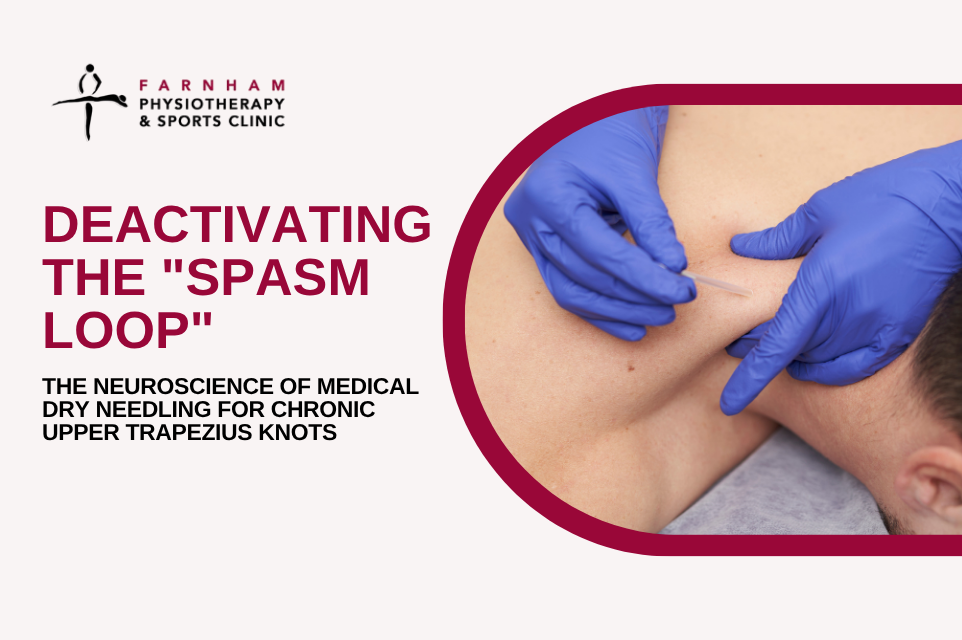 Deactivating the “Spasm Loop”: The Neuroscience of Medical Dry Needling for Chronic Upper Trapezius Knots